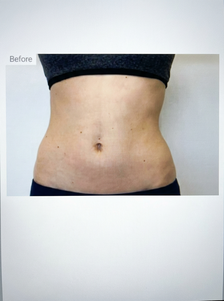 EMSCULPT Abs Before