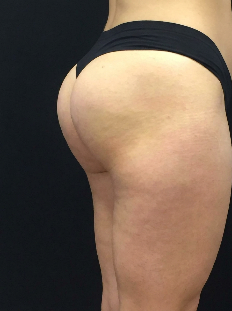 EMSCULPT buttocks after