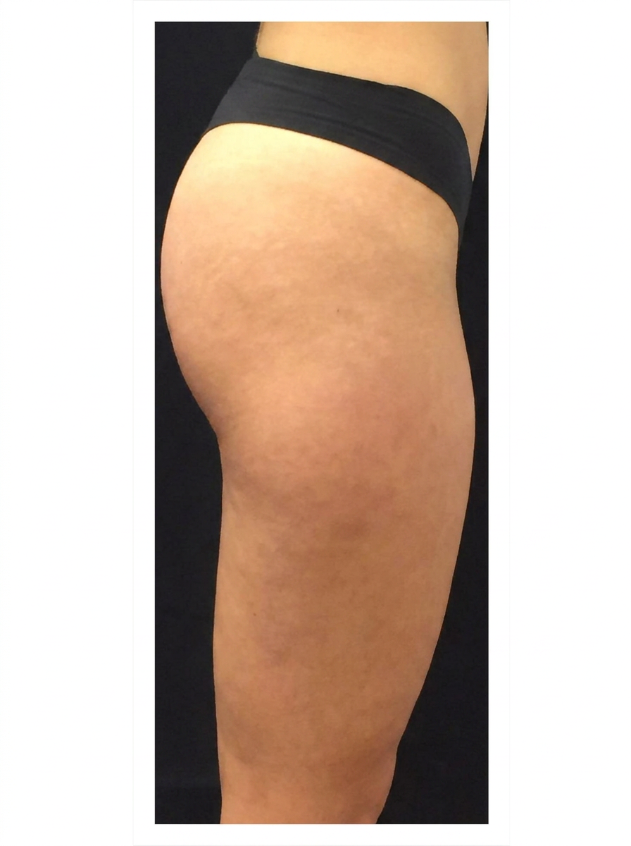 EMSCULPT buttocks before