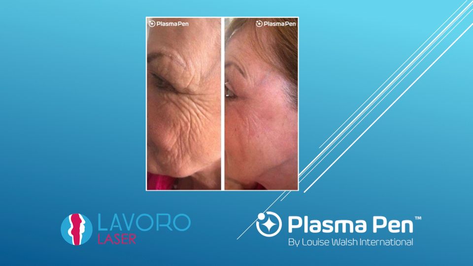 Plasma Pen cheek and temple wrinkles before and after
