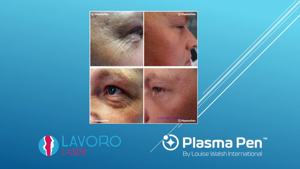 Plasma Pen eye and cheek area before and after