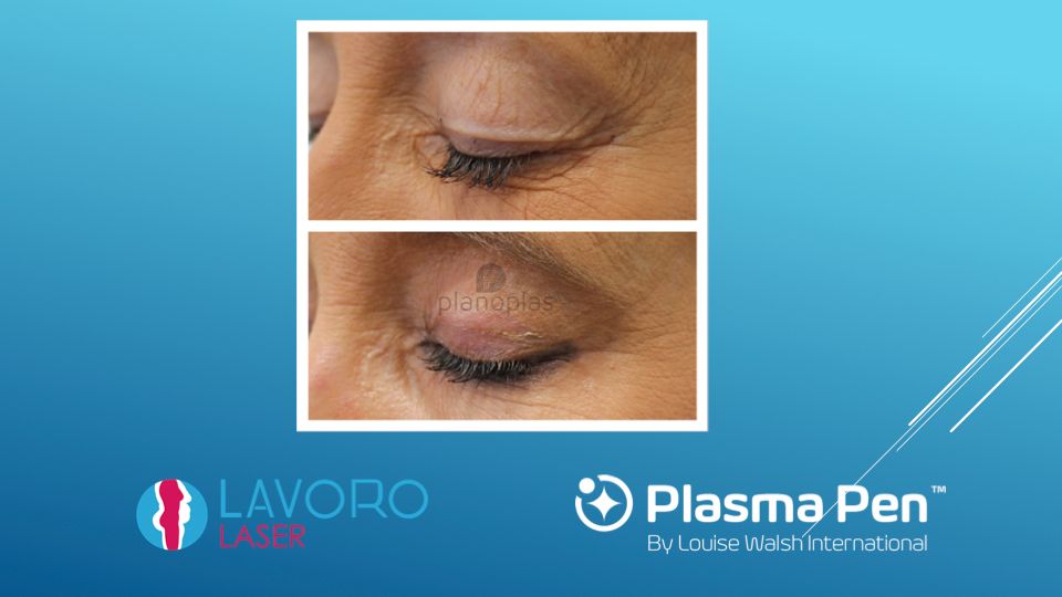 Plasma Pen crow's feet before and after