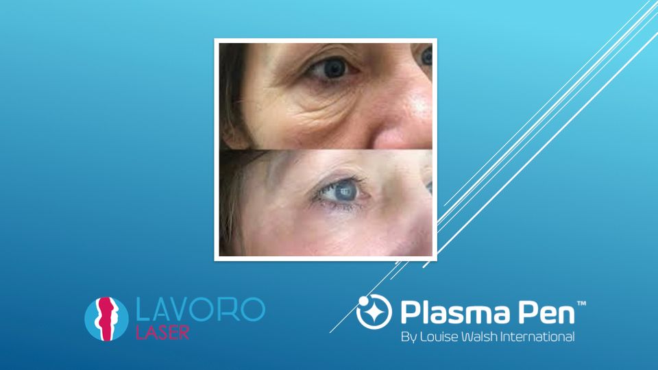 Plasma Pen eye area crow's feet before and after at Lavoro Laser