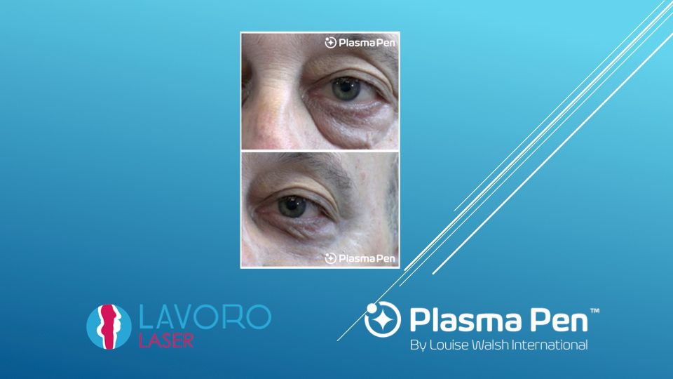 Plasma Pen hooded eyelid before and after