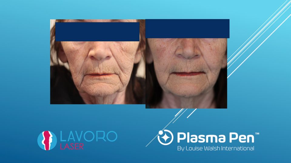 Plasma Pen full face before and after