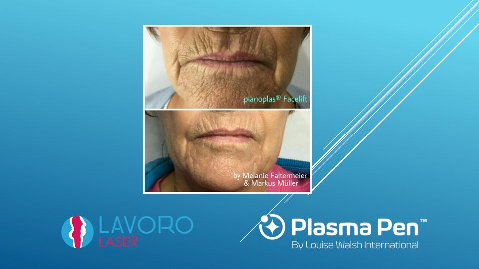 Plasma Pen severe facial wrinkles before and after