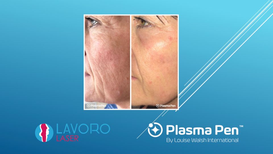 Plasma Pen facial wrinkles before and after