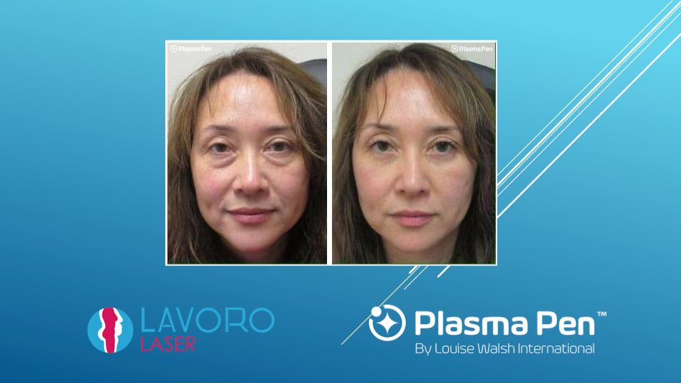 Plasma Pen skin tightening non-surgical facelift at Lavoro Laser Walnut Creek CA