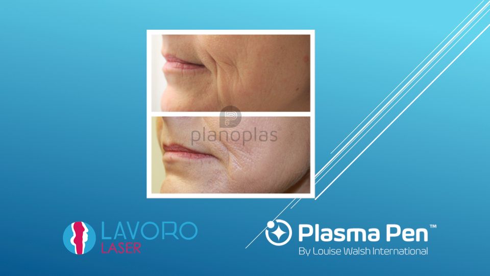 Plasma Pen nasolabial folds before and after