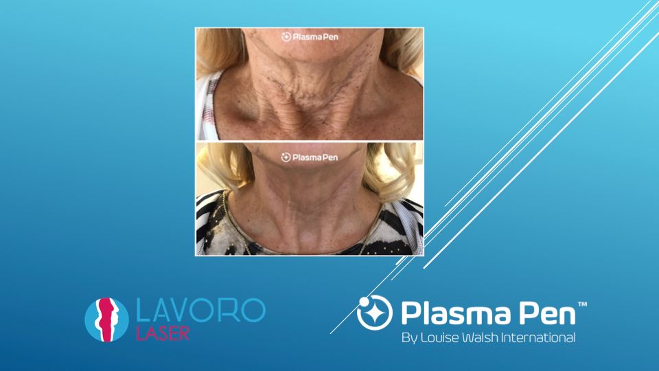 Plasma Pen neck tightening before and after