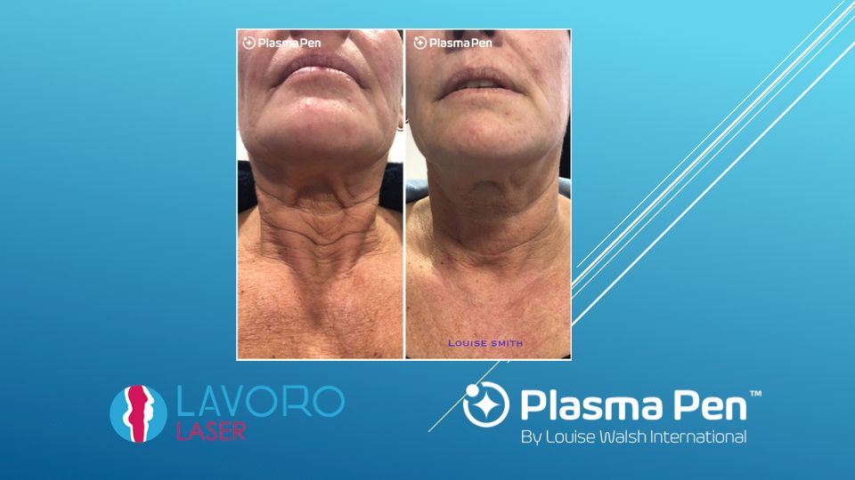 Plasma Pen neck and jowl before and after