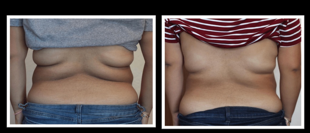 V-Shape Ultra Abdomen Before and After — Front View