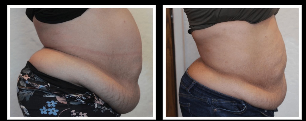 V-Shape Ultra Abdomen Before and After — Side Profile