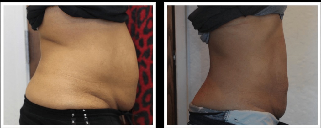 V-Shape Ultra Abdomen Before and After — Side Profile 2